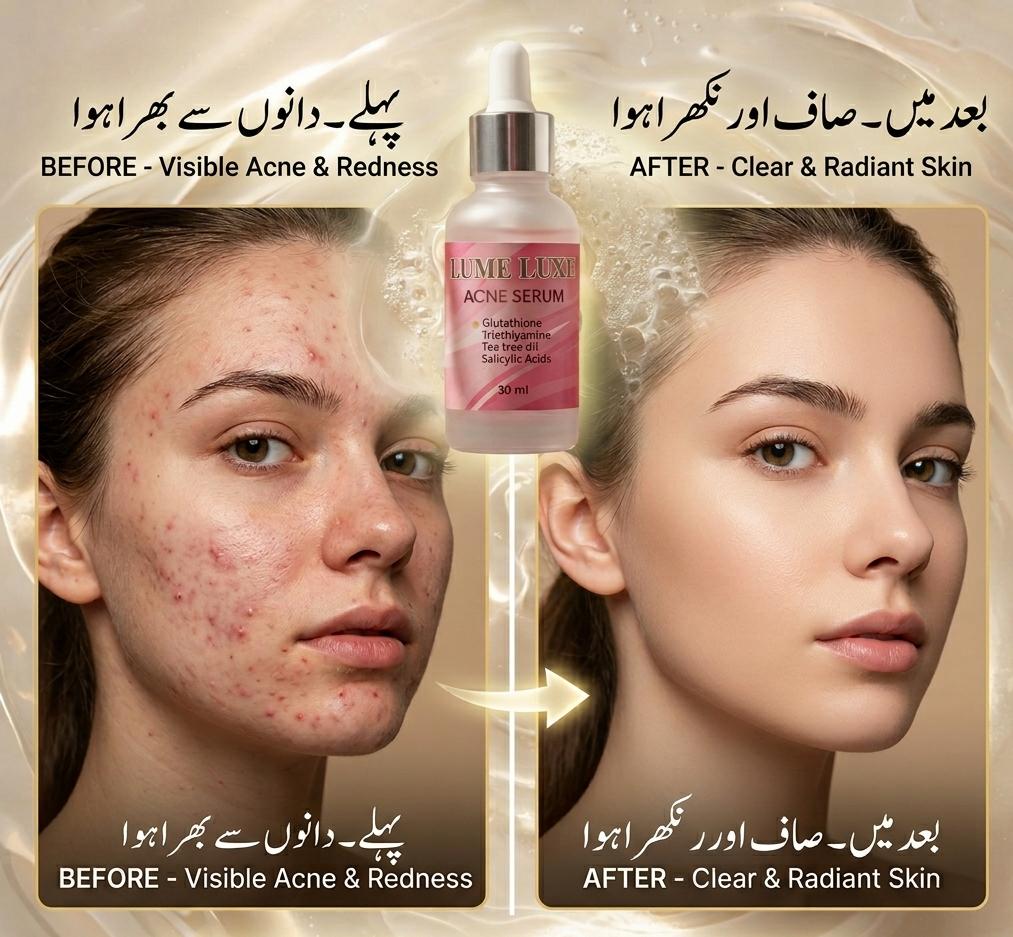 Lume Luxe Acne Control Serum